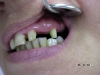 Obrúsenie zubov na schodík